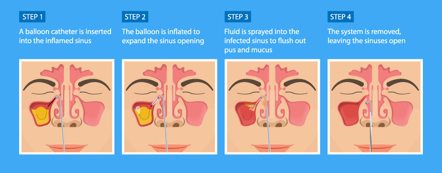 Services BalloonSinuplasy